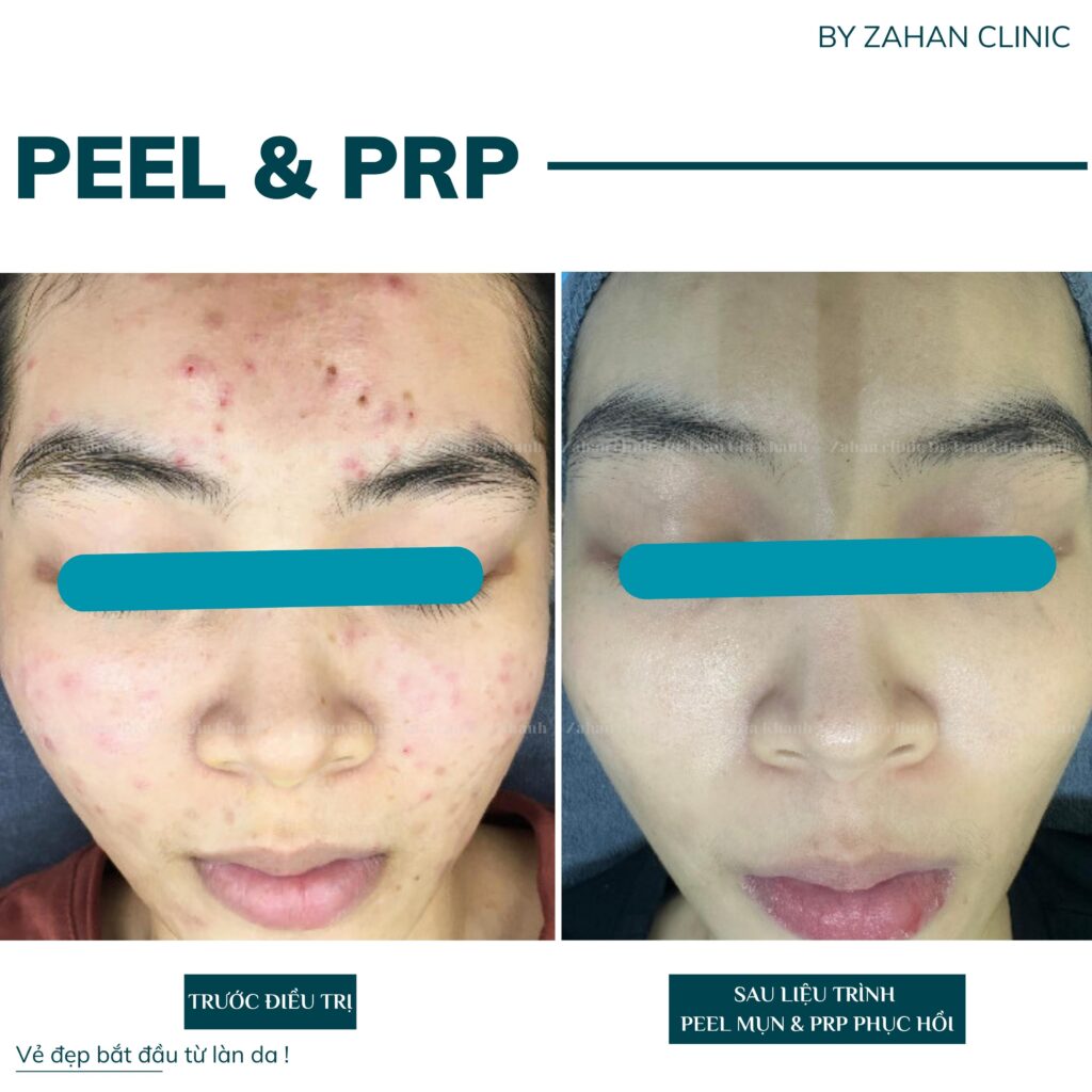 peel da tại zahan clinic